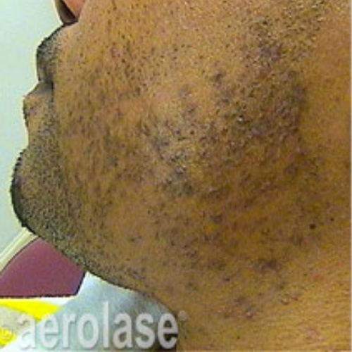 PFB – Before PFB - Before