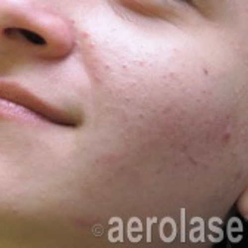 neoclear-after